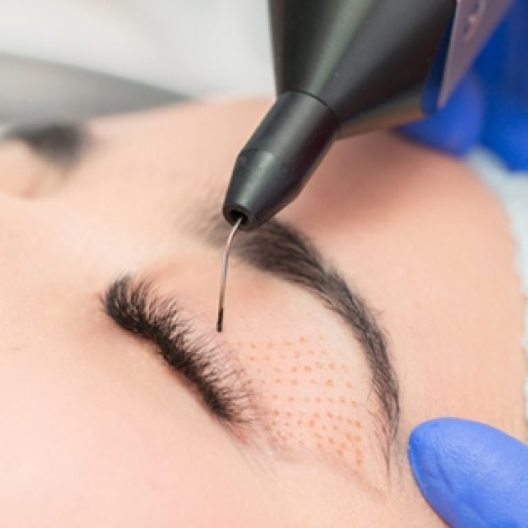 Plexr ile Göz Kapağı Düzeltimi